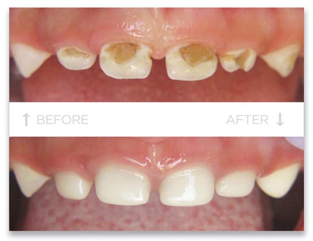 White Crowns For Children 4 Before And After An Aesthetic Pediatric Tooth Restoration With White Crowns On A Child'S Front Teeth
